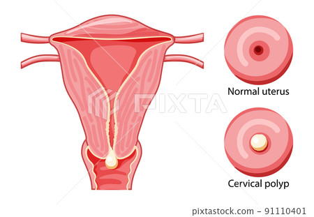 Set of Cervical Polyp in the uterus Female reproductive system in cross section and cervix view normal and with diseases Set of Cervical Polyp in the uterus Female reproductive system in cross section and cervix view normal and with diseases 91110401