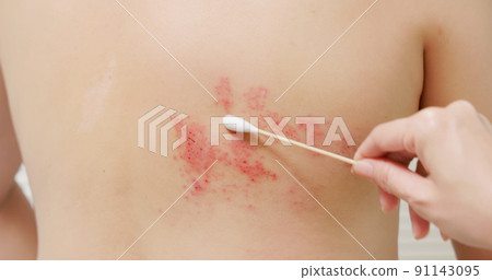 man with shingles disease man with shingles disease 91143095