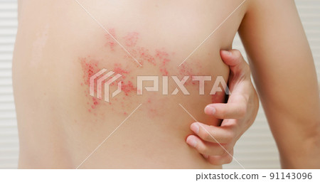 man with shingles disease 91143096