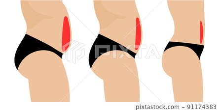 Liposuction fat plastic surgery fat change belly body cellulite shape. Cosmetic surgery vector woman Liposuction fat plastic surgery fat change belly body cellulite shape. Cosmetic surgery vector woman 91174383