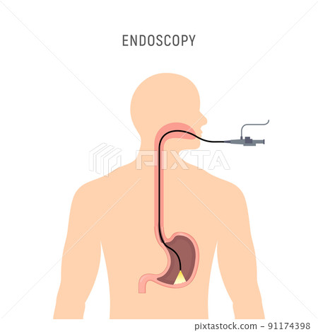 Endoscopy stomach anatomy equipment vector illustration. Esophagus endoscope body exam, gastroscopy 91174398