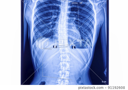 X ray showing scoliosis of the lumbar spine 91192608