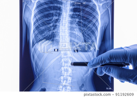 Doctor analyzing X ray of the spine showing scoliosis in the lumbar area Doctor analyzing X ray of the spine showing scoliosis in the lumbar area 91192609