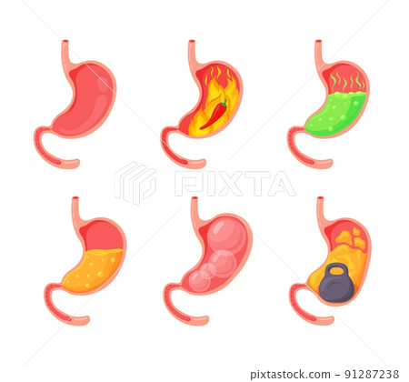 Empty and full stomach. Bloating stomach ache, gerd digestive tract pain fullness heaviness stomaches, acid heartburn process indigestion duodenum reflux, neat vector illustration Empty and full stomach. Bloating stomach ache, gerd digestive tract pain fullness heaviness stomaches, acid heartburn process indigestion duodenum reflux, neat vector illustration 91287238
