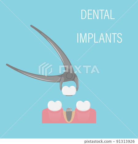 Dental implant installation. Aesthetic dentistry, modern medicine. Implant crown in forceps. A screw in the gum with a bone. Restoration of the dentition. Simple illustration in a flat style.Isolated 91313926