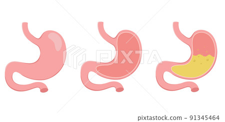 Healthy and unhealthy, empty and full human stomach. Digestive system anatomy. Vector illustration isolated on white background. 91345464