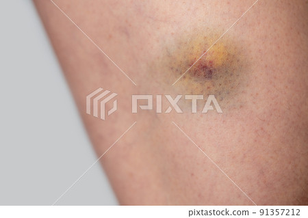 Bruises on the thighs Bruises on the thighs 91357212