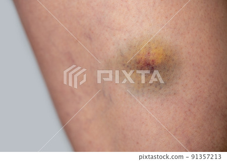 大腿上的瘀傷 91357213