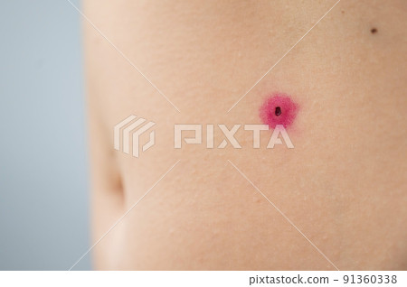 Close-up of a removed wart on a woman's abdomen. Human papillomavirus after burning. Close-up of a removed wart on a woman's abdomen. Human papillomavirus after burning. 91360338