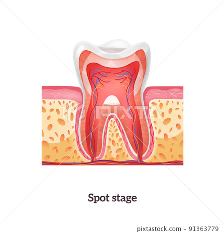 Realistic Caries Tooth Anatomy Realistic Caries Tooth Anatomy 91363779