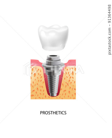 Dental Implantation Prosthetics Composition Dental Implantation Prosthetics Composition 91364498