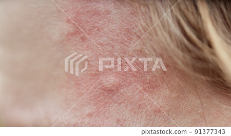 Bite mark, sting or sore on human skin. Close up of symptoms. Healthcare theme. Bite mark, sting or sore on human skin. Close up of symptoms. Healthcare theme. 91377343