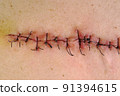 Medical sutures, stitches after surgery, stitched surgical sutures on human body. Medical surgical care. 91394615