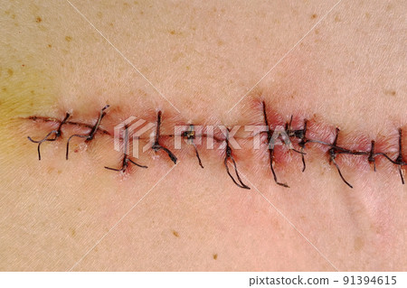 Medical sutures, stitches after surgery, stitched surgical sutures on human body. Medical surgical care. Medical sutures, stitches after surgery, stitched surgical sutures on human body. Medical surgical care. 91394615