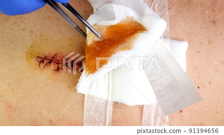 Medical sutures, stitch after surgery, stitched surgical sutures on human body smeared betadine. Medical sutures, stitch after surgery, stitched surgical sutures on human body smeared betadine. 91394656