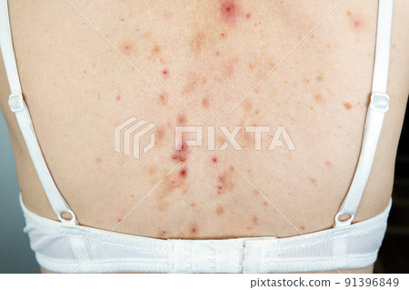 Acne sequelae, torn pimples, skin itching on the back, dermatological problem.  91396849