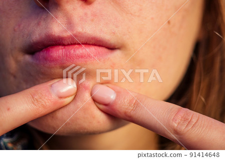post-acne, scars and red festering pimples on the face of a young woman. concept of skin problems post-acne, scars and red festering pimples on the face of a young woman. concept of skin problems 91414648