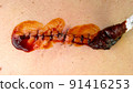 Medical sutures, stitch after surgery, stitched surgical sutures on human body smeared betadine. 91416253