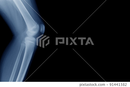 lateral view of knee joint 91441382