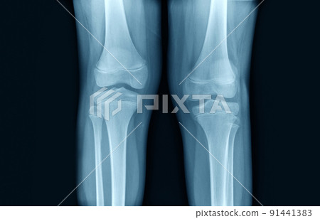 knee joint x ray in blue tone 91441383