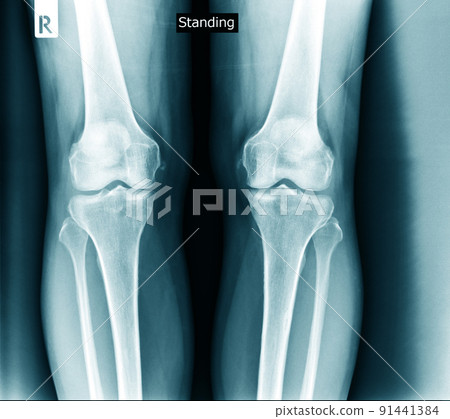 knee joint x ray degeneration knee joint x ray degeneration 91441384
