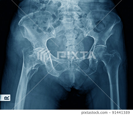 x ray image of pelvic bone 91441389