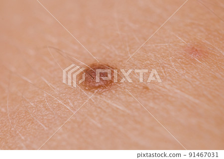 Closeup brown mole on caucasian woman skin. Closeup brown mole on caucasian woman skin. 91467031