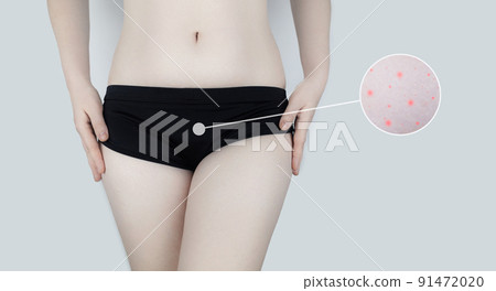Irritation of the skin of the bikini area. consequences of depilation. Skin injuries. Pimples and redness after shaving. Panty area care concept. Sugaring and waxing. Cream against acne and redness 91472020