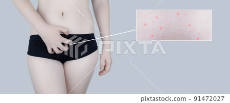 Irritation of the skin of the bikini area. consequences of depilation. Skin injuries. Pimples and redness after shaving. Panty area care concept. Sugaring and waxing. Cream against acne and redness 91472027