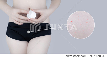Irritation of the skin of the bikini area. consequences of depilation. Skin injuries. Pimples and redness after shaving. Panty area care concept. Sugaring and waxing. Cream against acne and redness 91472031