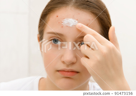girl puts cream on her face, face of a teenage girl with pimples, acne on the skin, she looks at herself in the mirror, concept of beauty and health 91473156