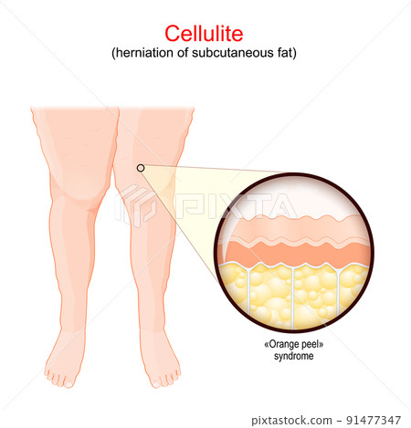 Cellulite. Females legs. human skin with Orange peel syndrome. Cellulite. Females legs. human skin with Orange peel syndrome. 91477347
