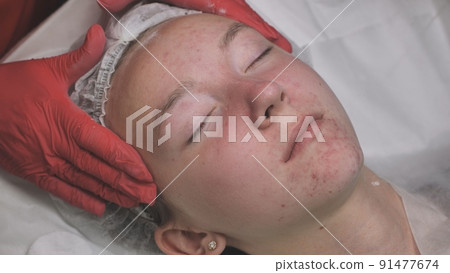 Applying powder to the client's face and massage the client's problem skin. Applying powder to the client's face and massage the client's problem skin. 91477674