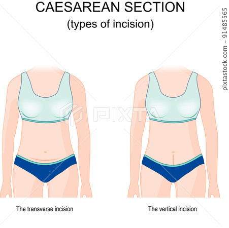 caesarean section. types of incision. 91485565