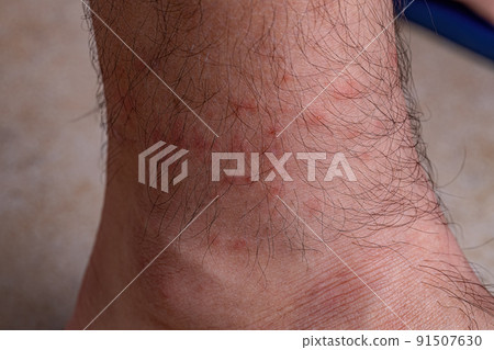 allergic reactions to tick bites allergic reactions to tick bites 91507630