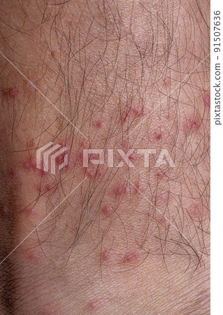 allergic reactions to tick bites 91507636