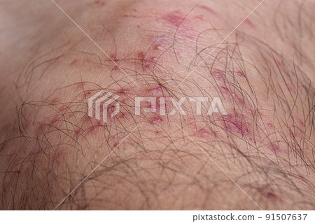 allergic reactions to tick bites allergic reactions to tick bites 91507637
