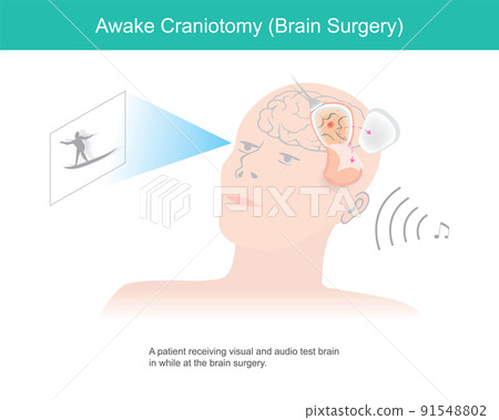 Awake craniotomy. A patient receiving visual and audio test brain in while at brain surgery. Awake craniotomy. A patient receiving visual and audio test brain in while at brain surgery. 91548802
