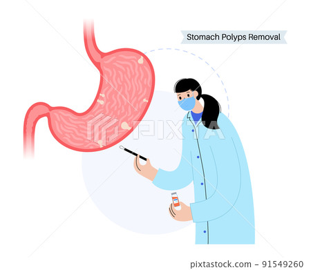 Stomach polyp removal 91549260