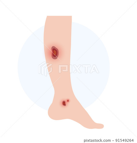 Trophic ulcer anatomy Trophic ulcer anatomy 91549264
