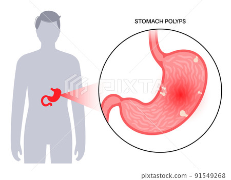 Stomach polyp disease 91549268