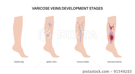 Varicose veins treatment 91549283