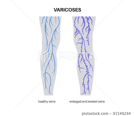 Varicose veins treatment Varicose veins treatment 91549284
