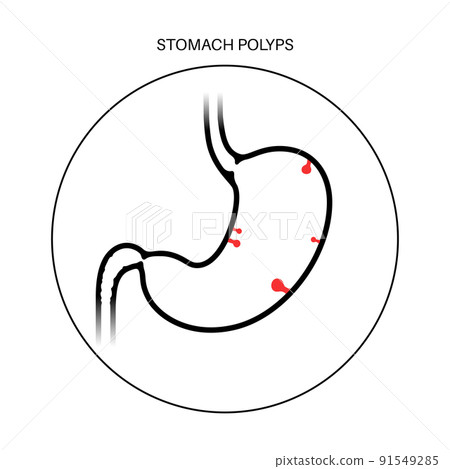 Stomach polyp disease 91549285