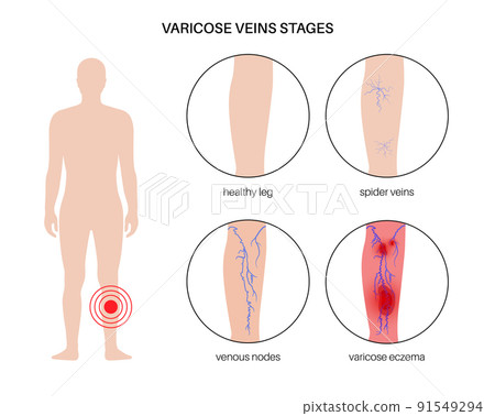 Varicose veins treatment Varicose veins treatment 91549294