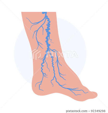 Varicose veins treatment Varicose veins treatment 91549298