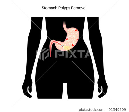 Stomach polyp removal 91549309