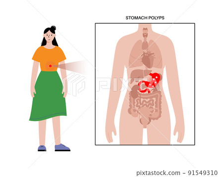 Stomach polyp disease Stomach polyp disease 91549310