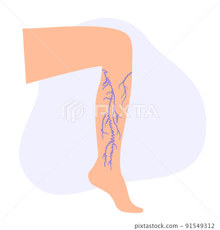 Varicose veins treatment Varicose veins treatment 91549312