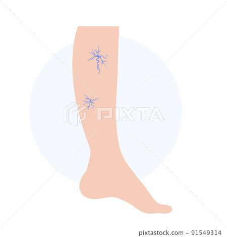 Spider veins treatment Spider veins treatment 91549314